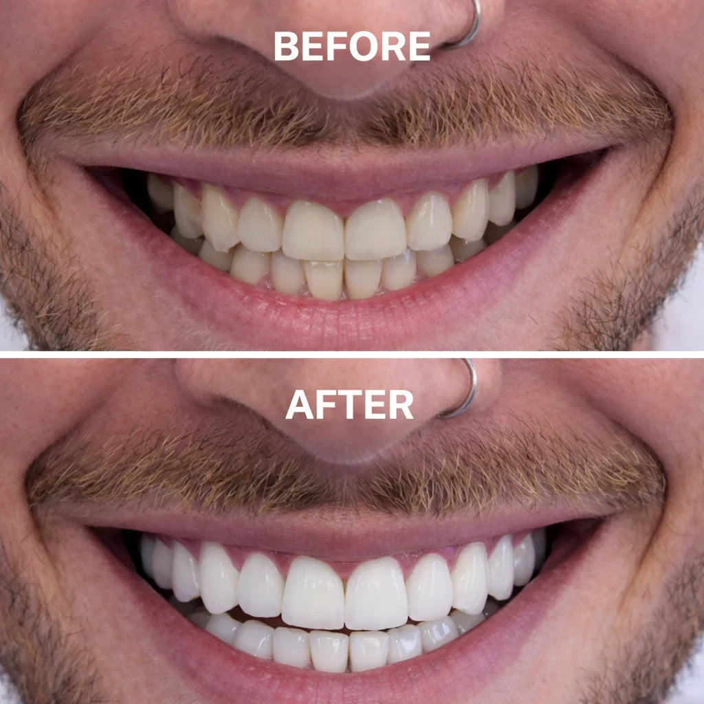 PURPLE WHITENING STRIPS (Gen2)