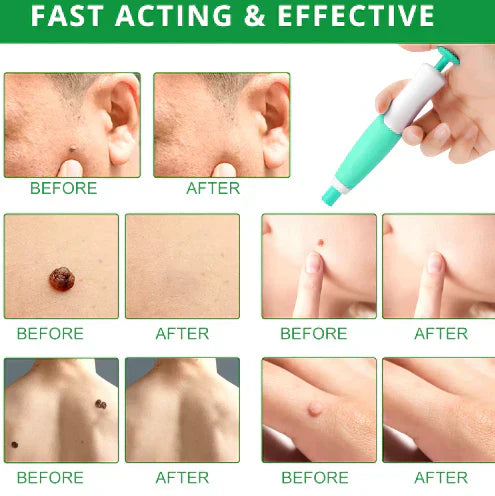 Zavinox 2-in-1 Painless Skin Tag, Mole, and Wart Removal Kit